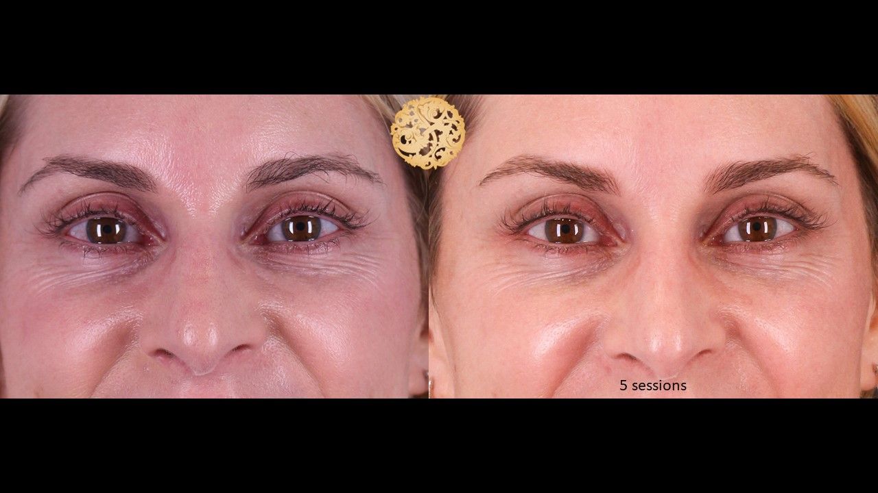 Pelleve Before & After