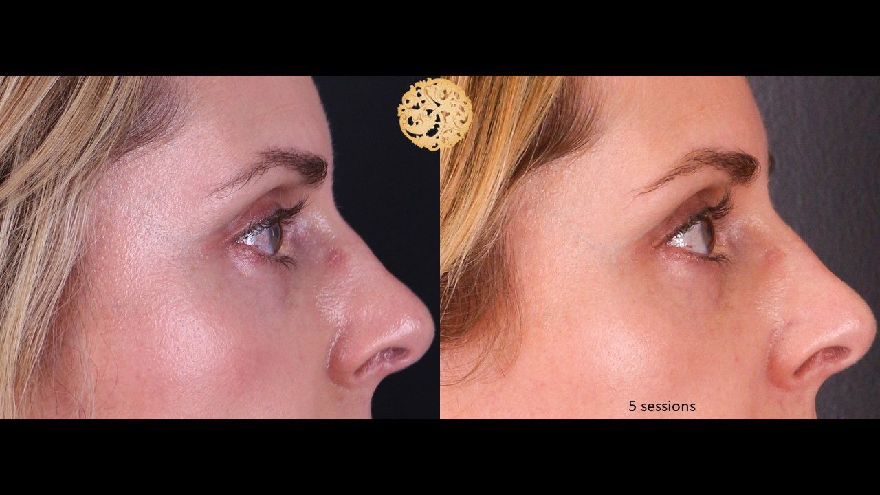 Pelleve Before & After