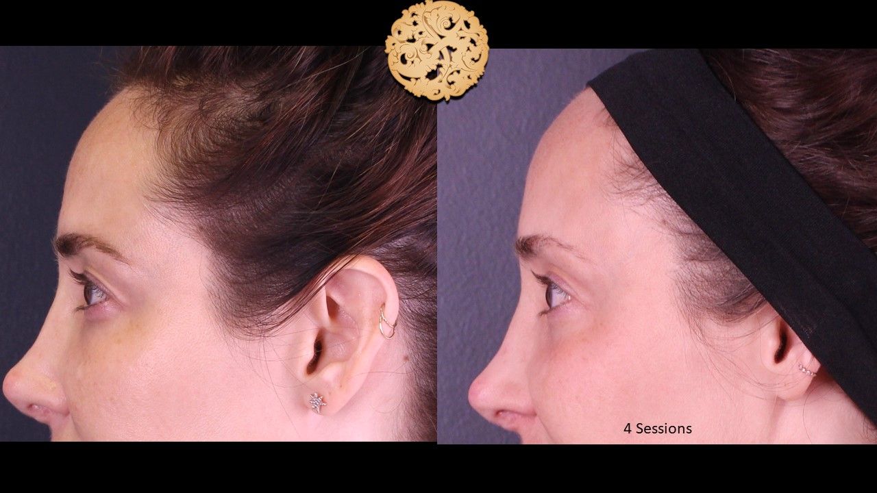 Pelleve Before & After