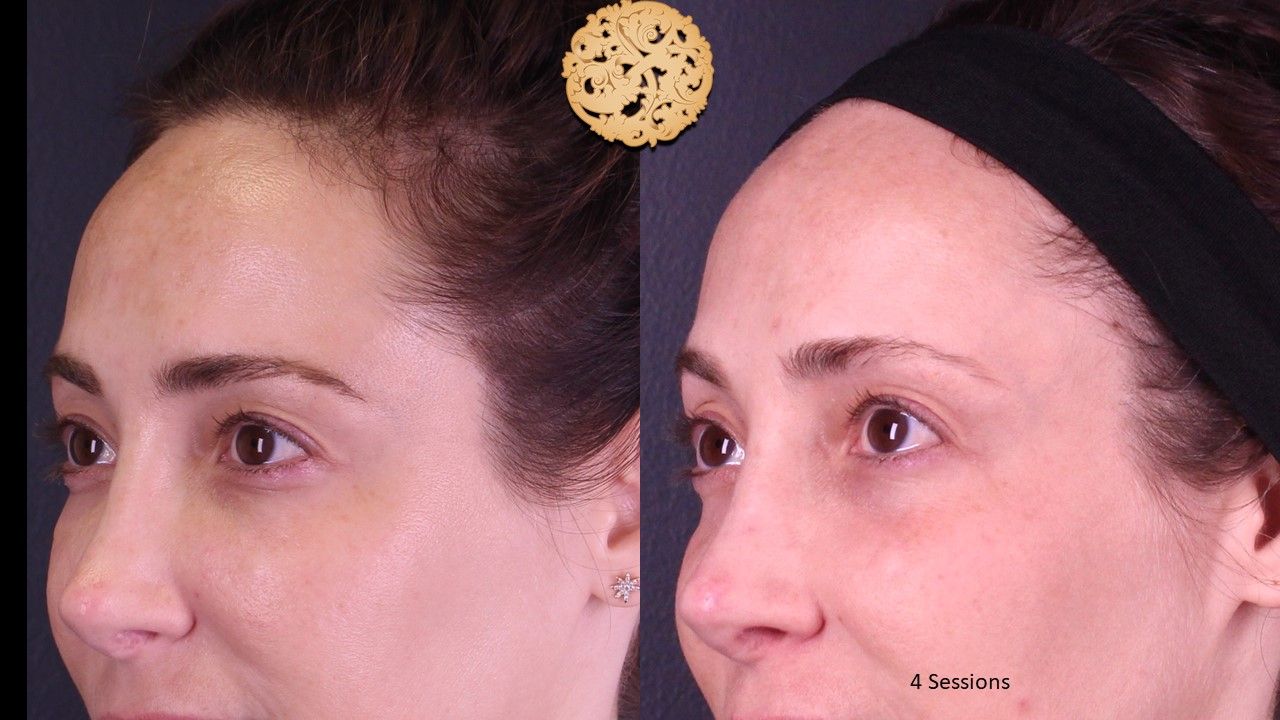 Pelleve Before & After