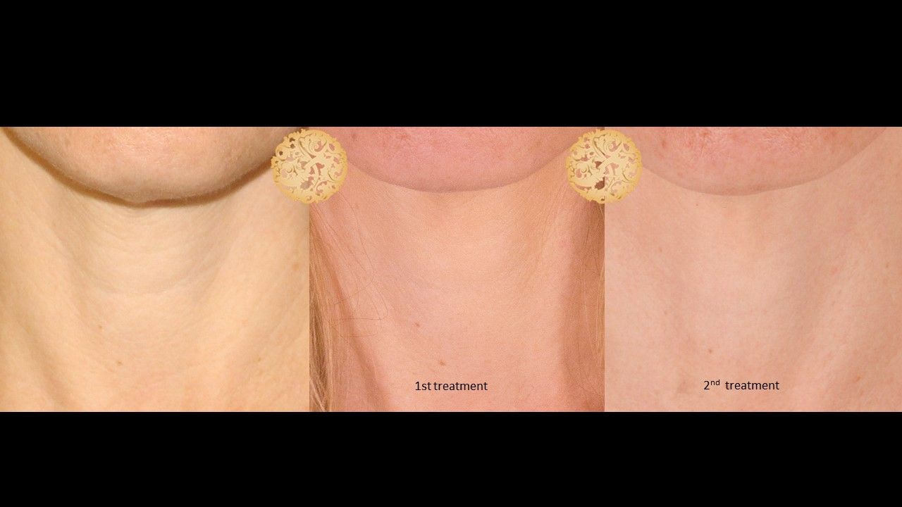 Pelleve Before & After