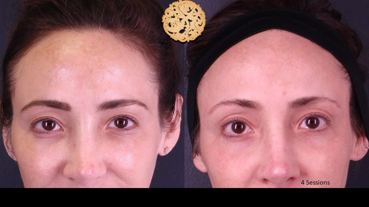 Pelleve Before & After