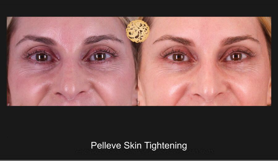 Pelleve Before & After