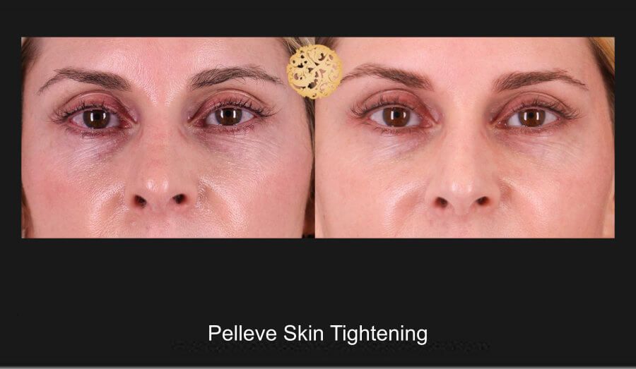 Pelleve Before & After