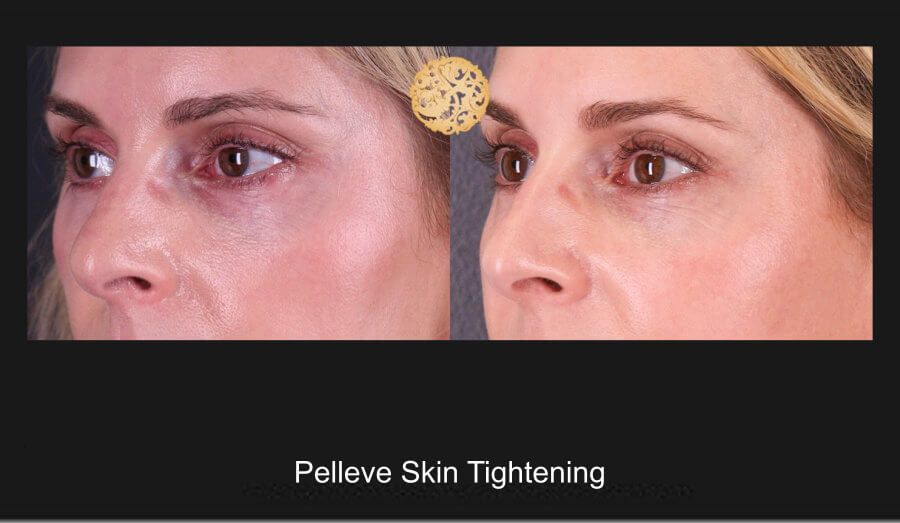 Pelleve Before & After