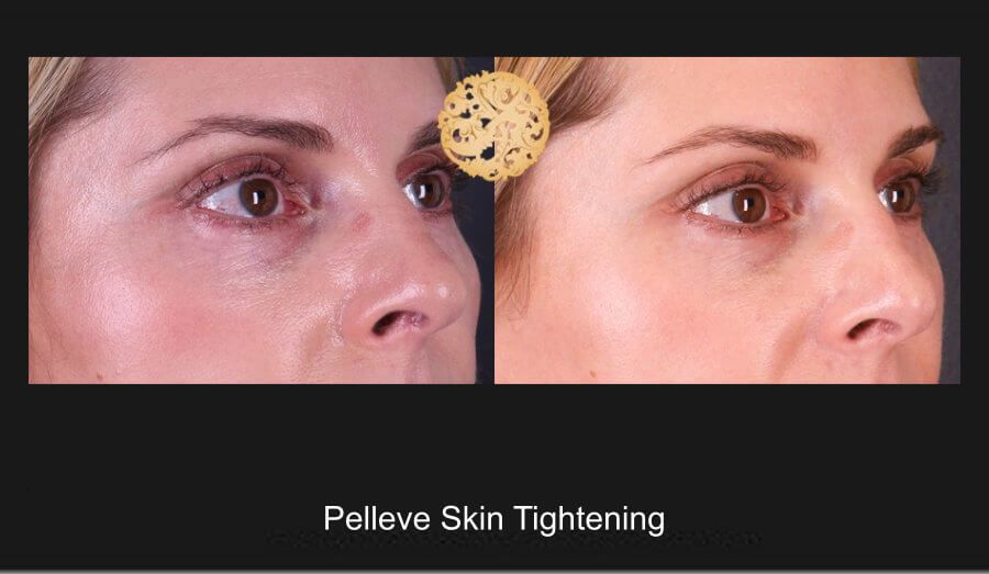 Pelleve Before & After