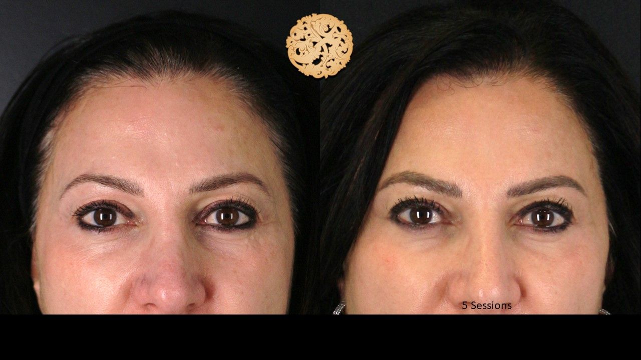 Pelleve Before & After