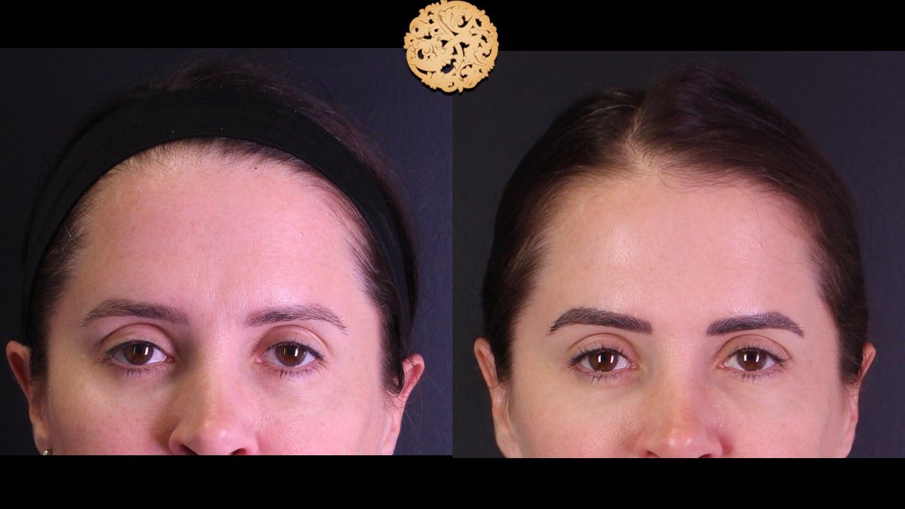 Pelleve Before & After