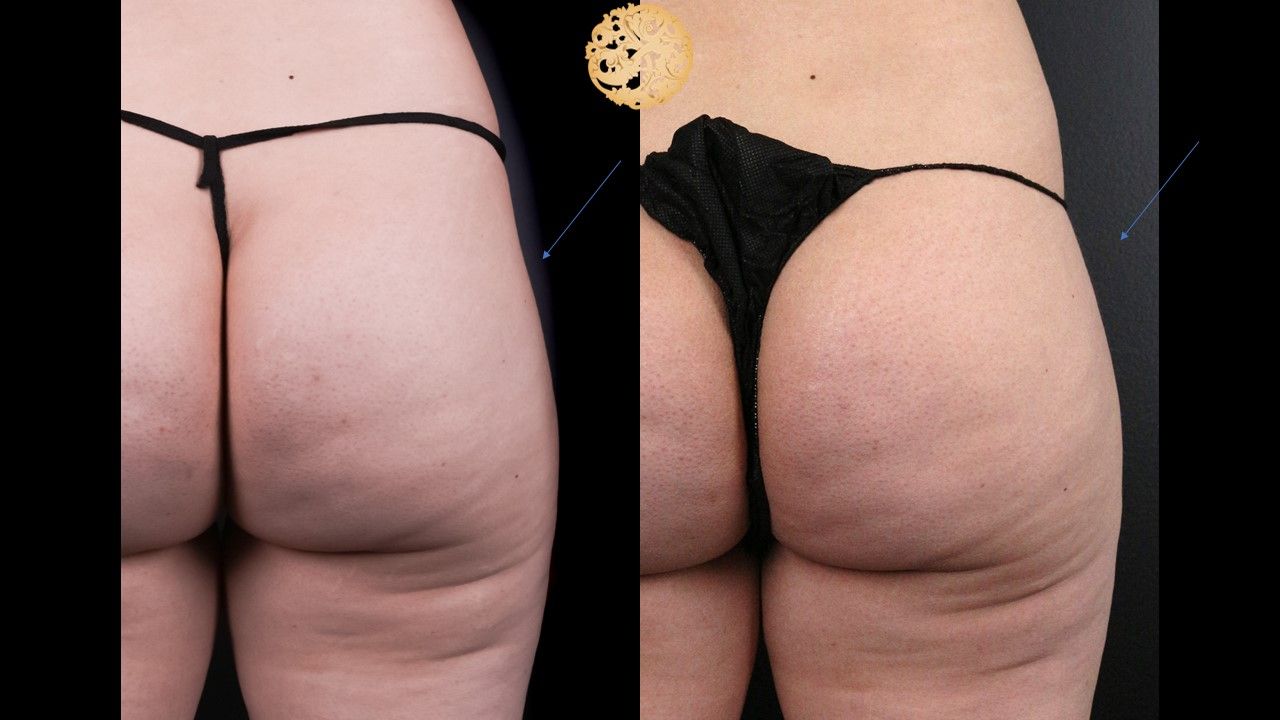 Butt Coolsculpting Before & After