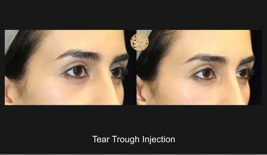 Under Eye Filler Before & After
