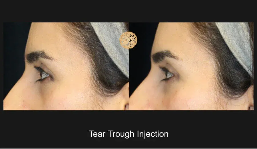 Under Eye Filler Before & After
