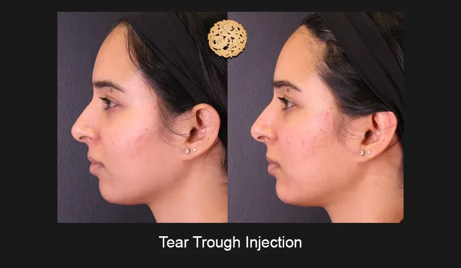 Under Eye Filler Before & After