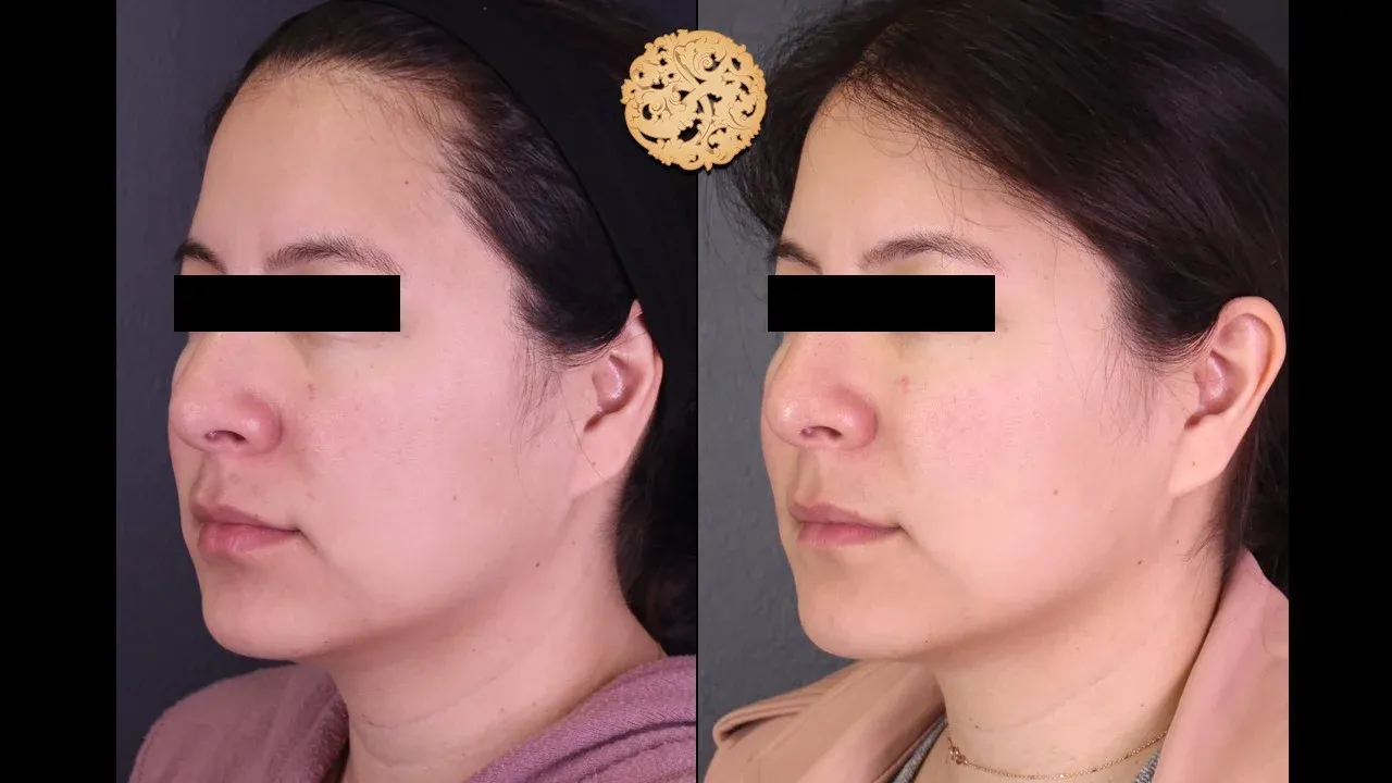 Under Eye Filler Before & After
