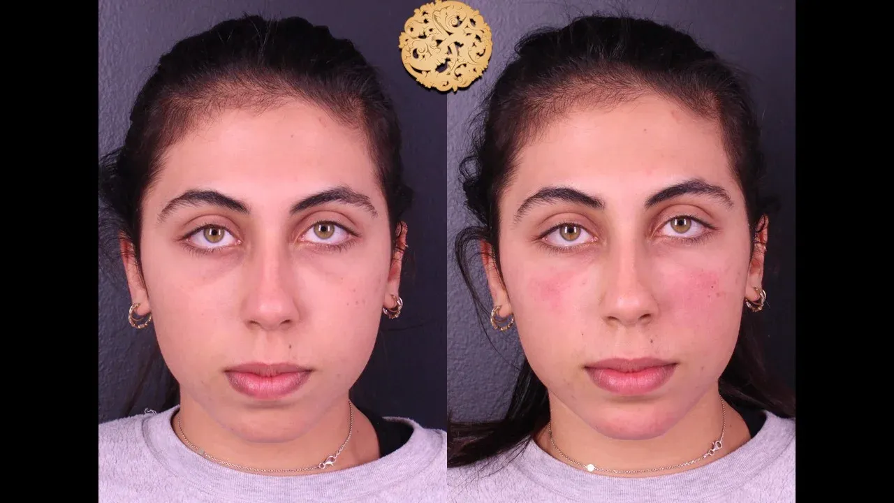 Under Eye Filler Before & After