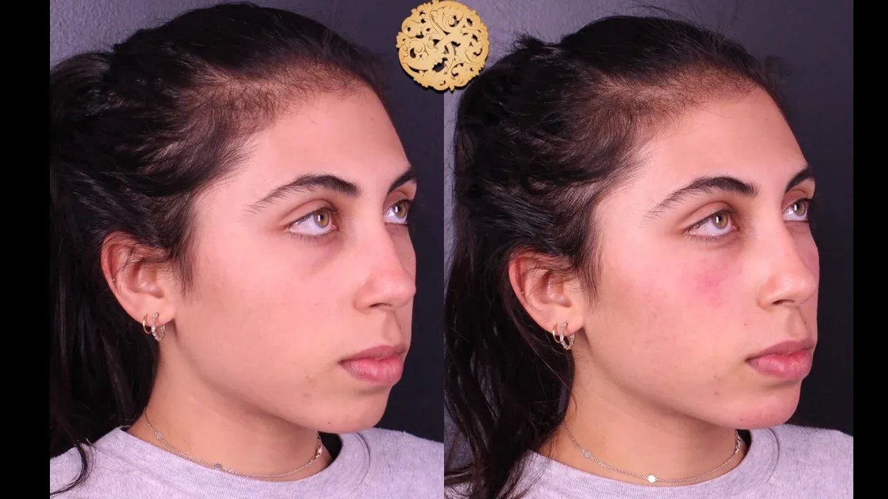 Under Eye Filler Before & After