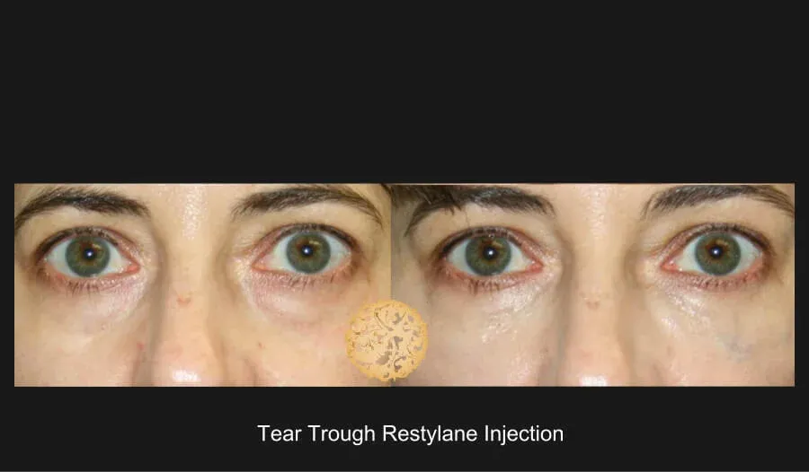 Under Eye Filler Before & After