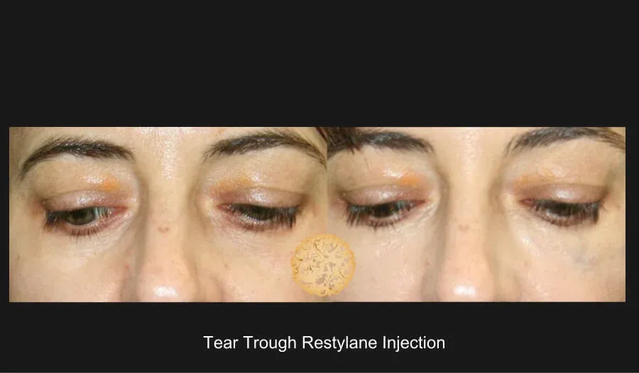 Under Eye Filler Before & After