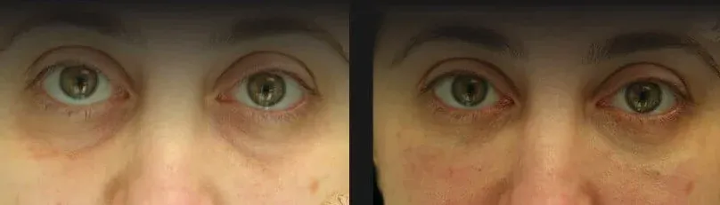 Under Eye Filler Before & After