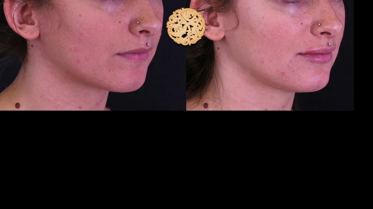 Under Eye Filler Before & After