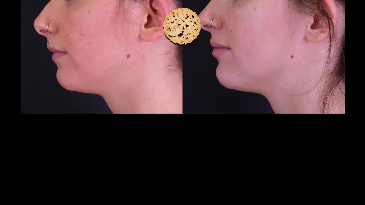 Under Eye Filler Before & After