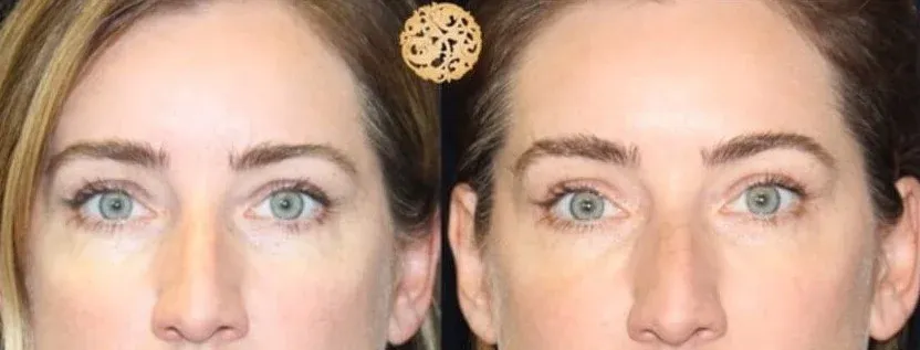 Under Eye Filler Before & After