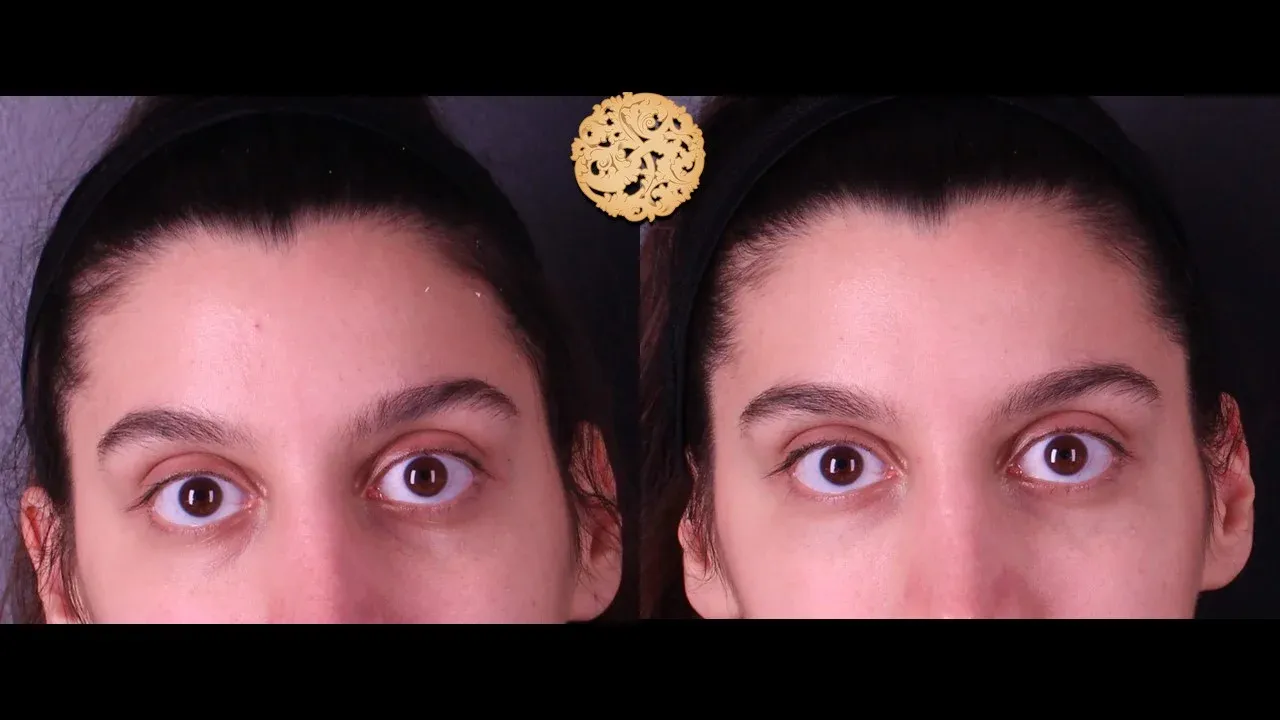 Under Eye Filler Before & After