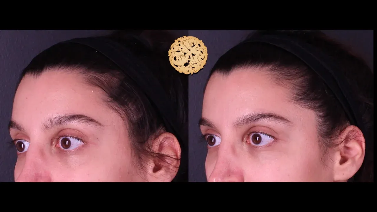 Under Eye Filler Before & After