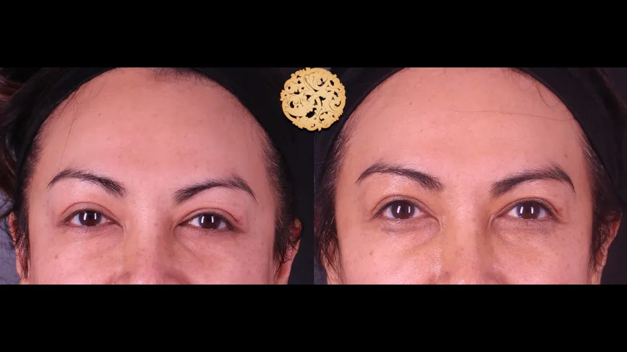 Under Eye Filler Before & After