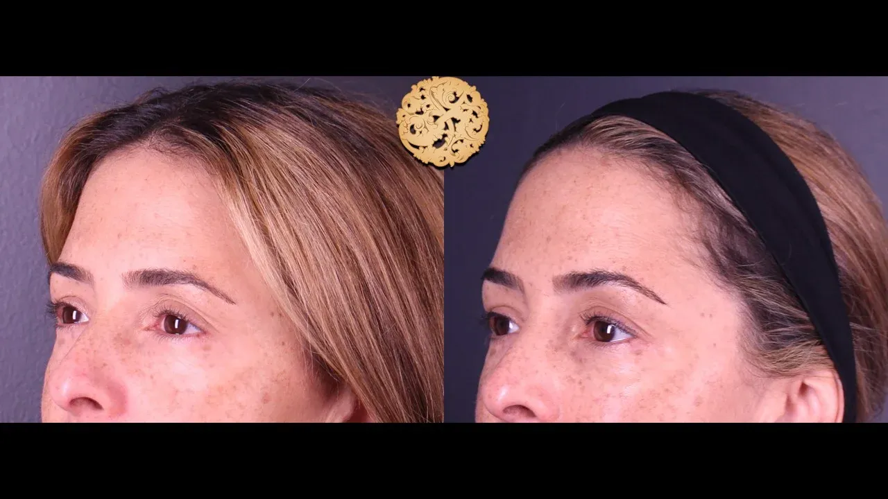 Under Eye Filler Before & After
