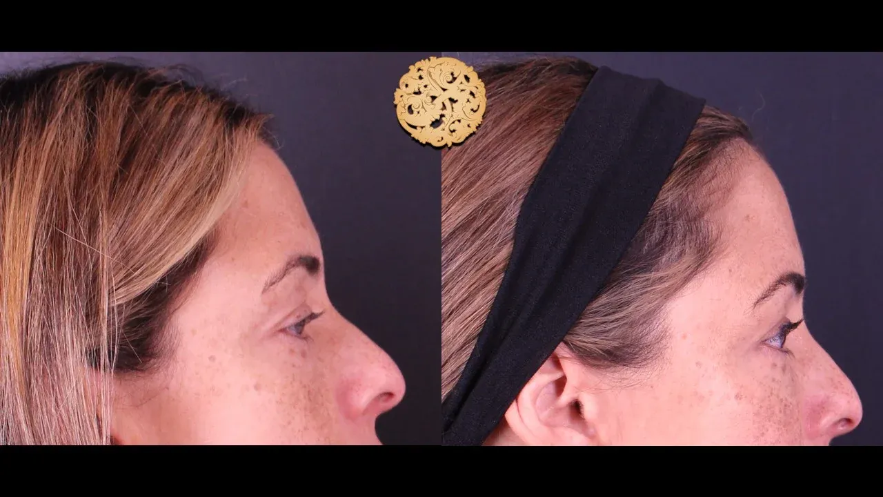 Under Eye Filler Before & After
