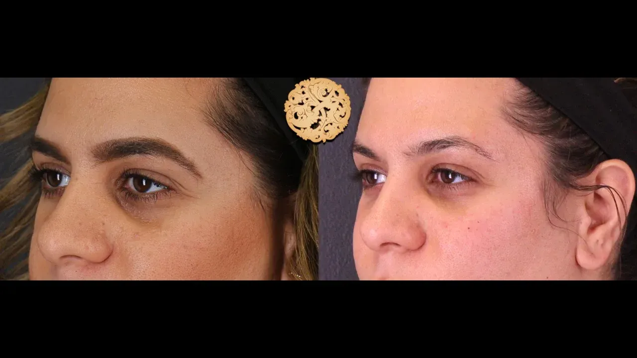 Under Eye Filler Before & After