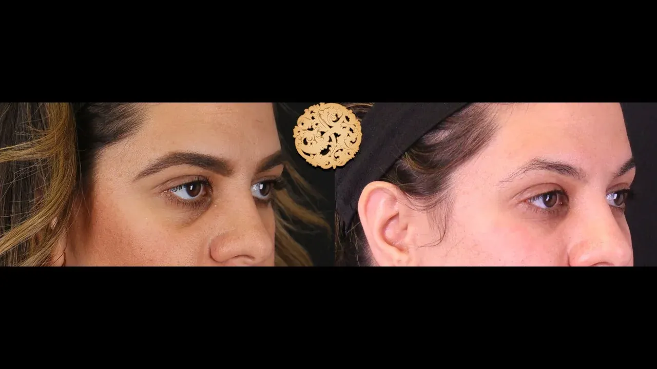 Under Eye Filler Before & After