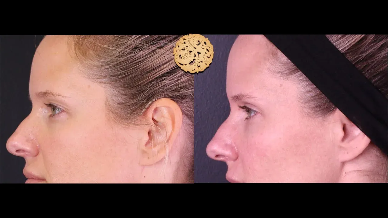 Under Eye Filler Before & After