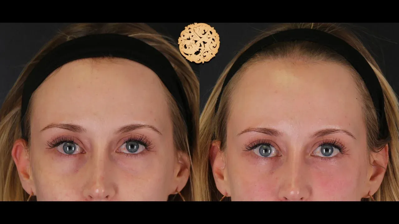 Under Eye Filler Before & After