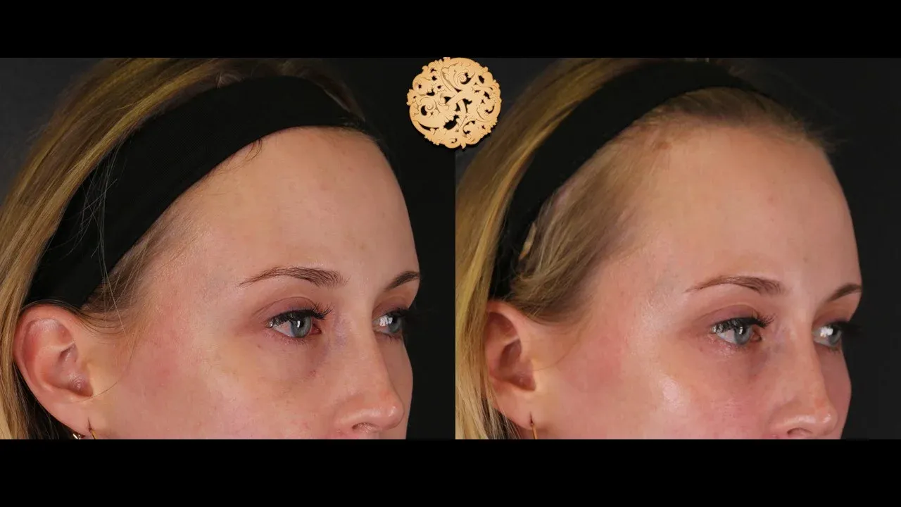 Under Eye Filler Before & After