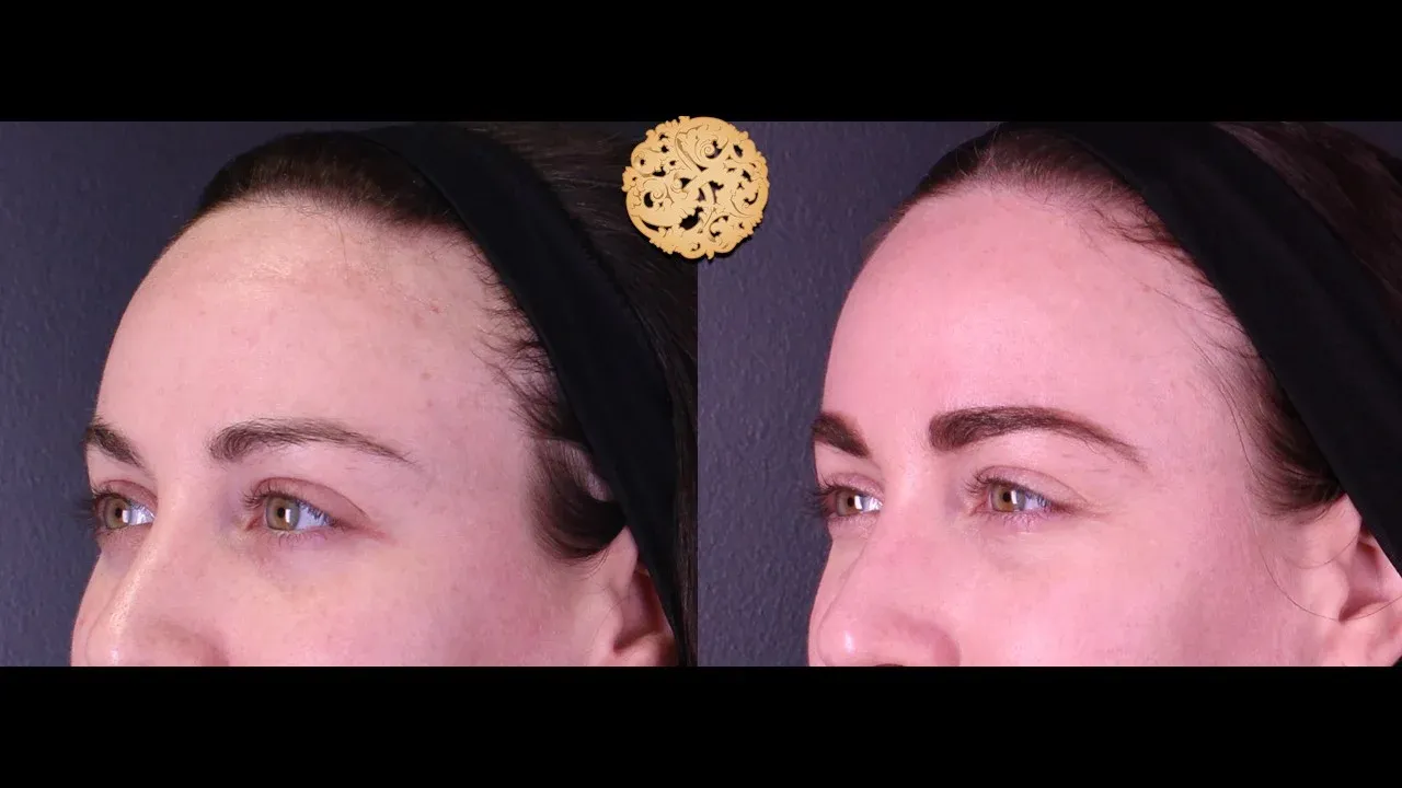 Under Eye Filler Before & After