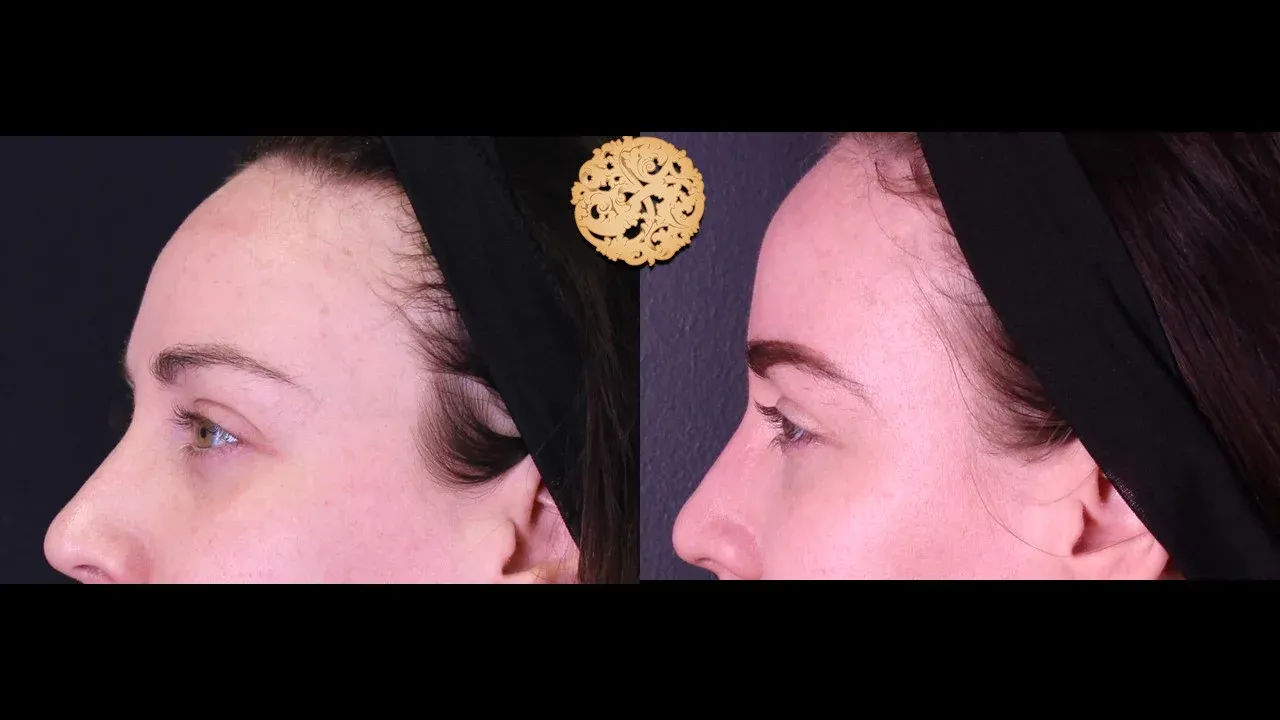 Under Eye Filler Before & After