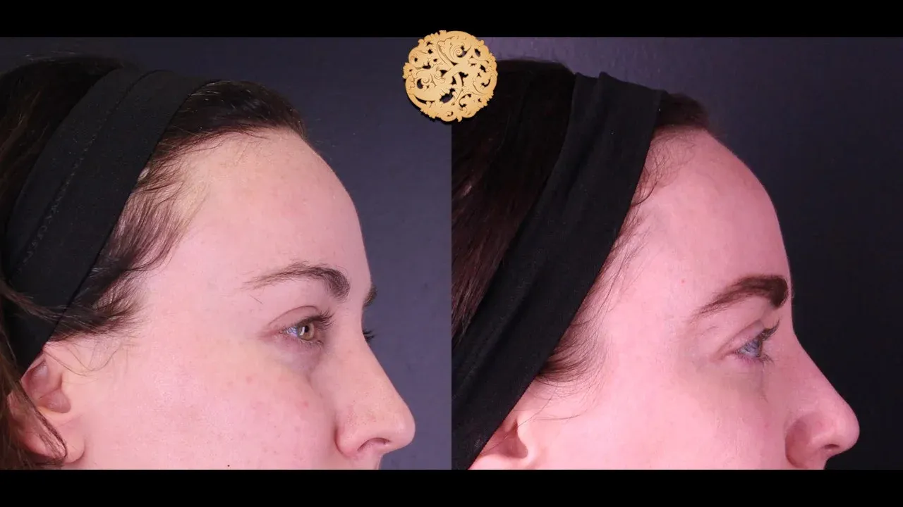 Under Eye Filler Before & After