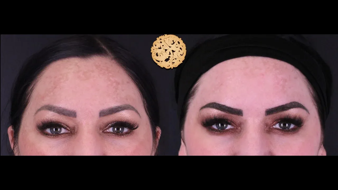 Under Eye Filler Before & After