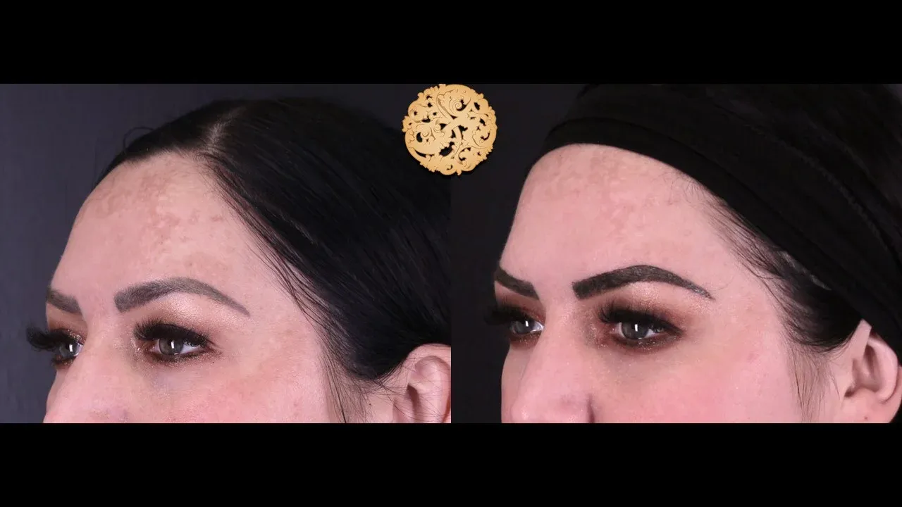 Under Eye Filler Before & After