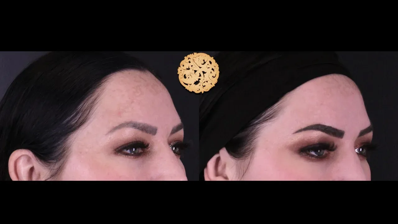 Under Eye Filler Before & After