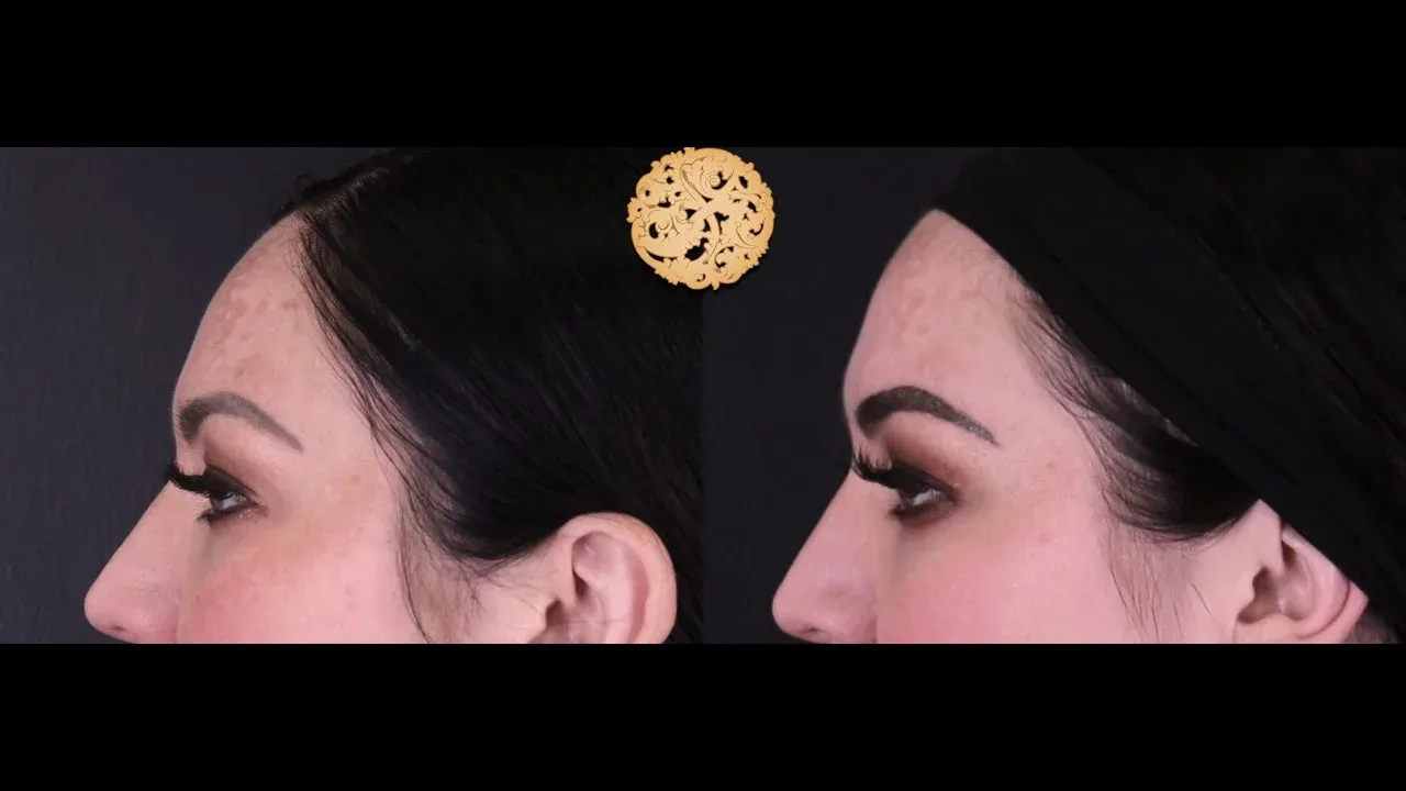 Under Eye Filler Before & After