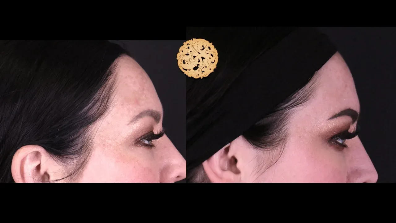 Under Eye Filler Before & After