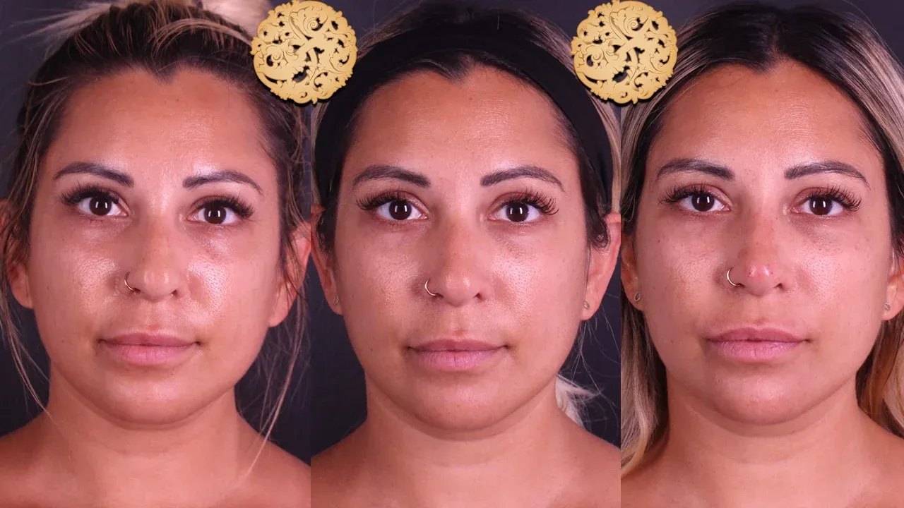 Under Eye Filler Before & After