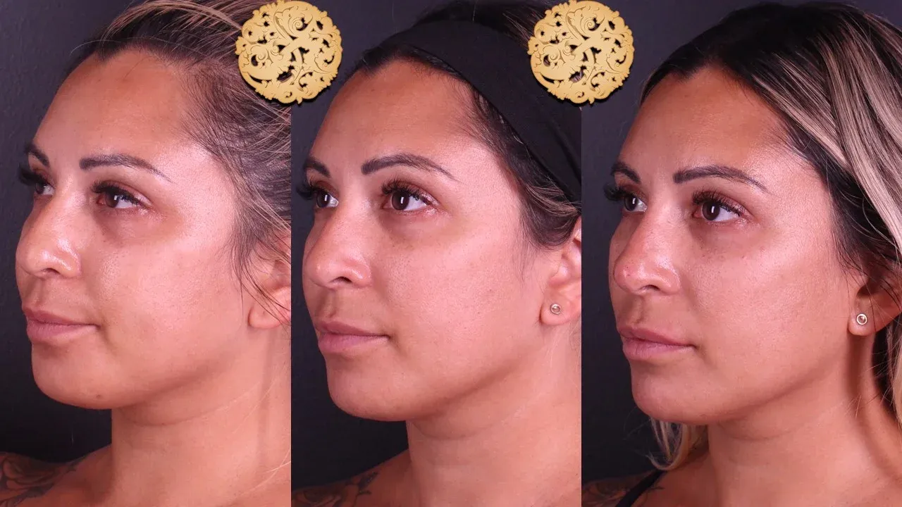 Under Eye Filler Before & After
