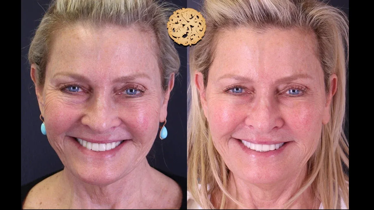 Under Eye Filler Before & After