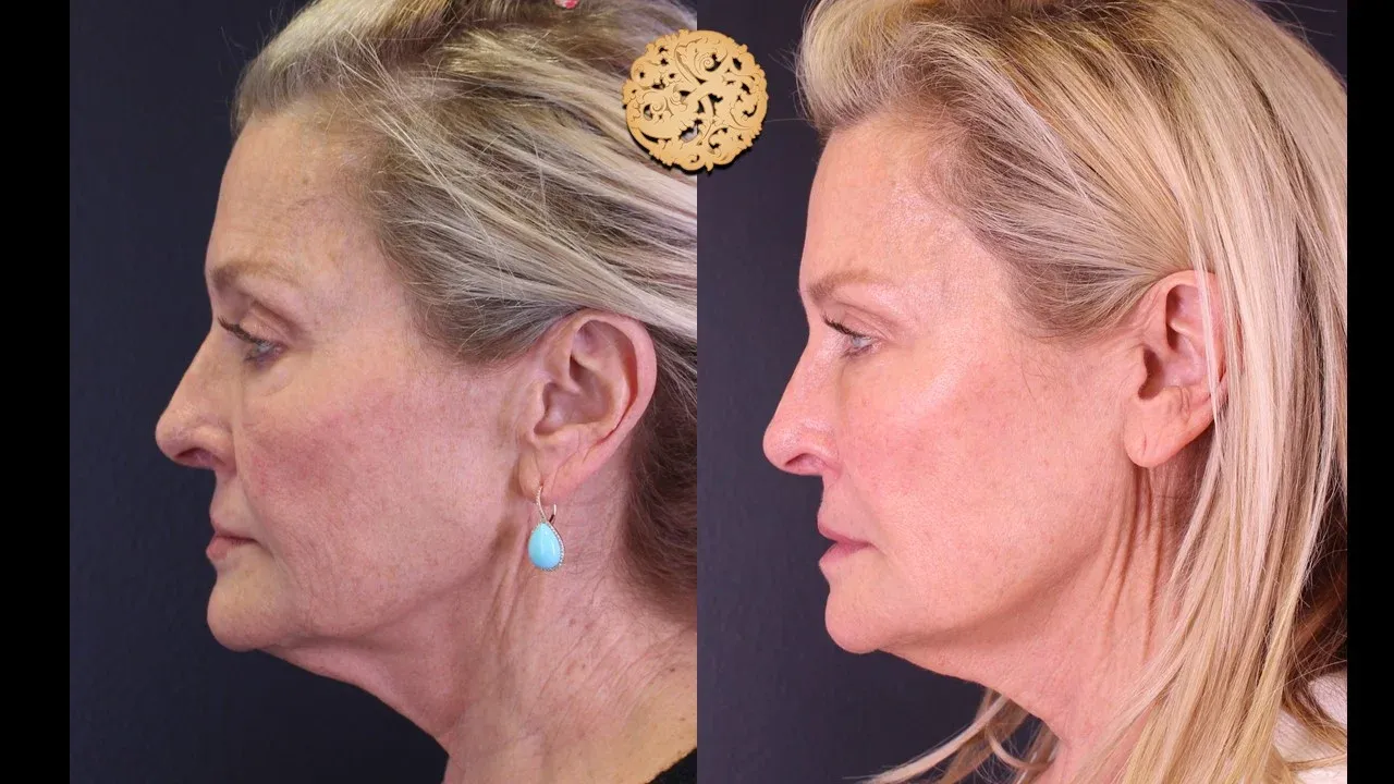 Under Eye Filler Before & After