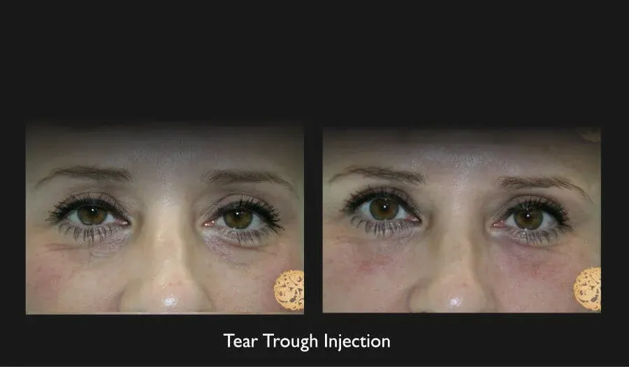 Under Eye Filler Before & After