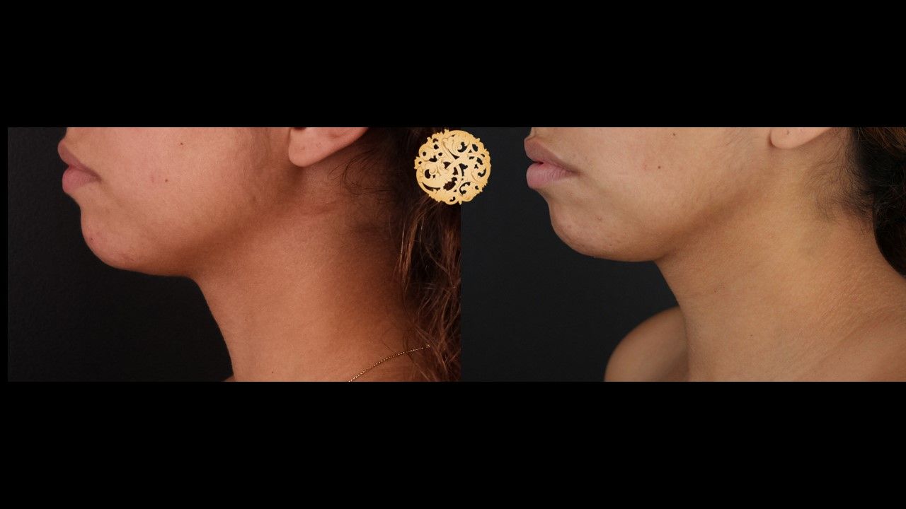 Face Liposuction Before & After