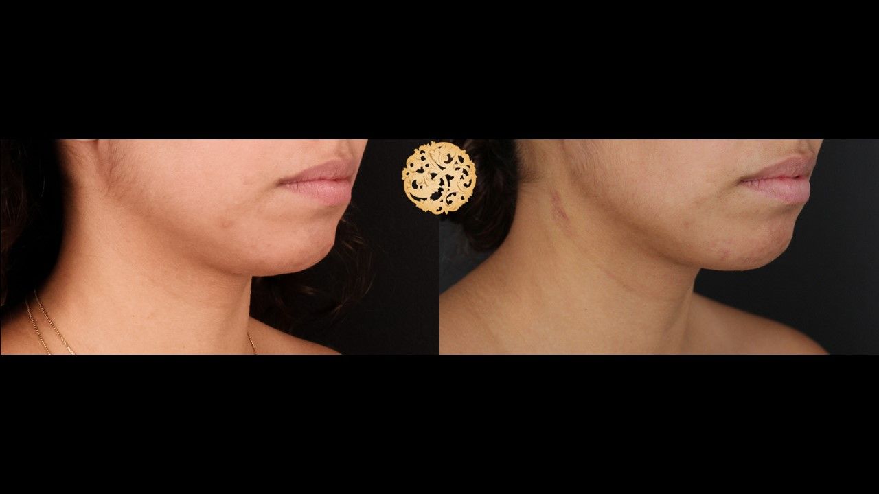 Face Liposuction Before & After